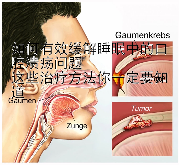 如何有效缓解睡眠中的口腔溃疡问题  
这些治疗方法你一定要知道